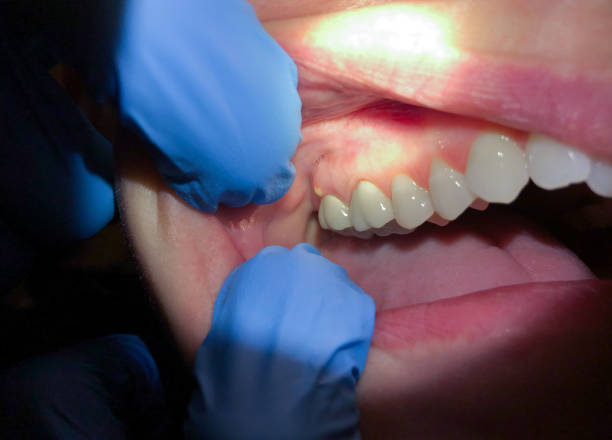 Best Emergency Dental Extractions in Martsville, IN